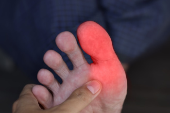 Swollen Big Toe