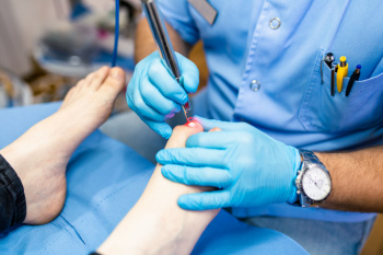 Laser Toenail Treatment