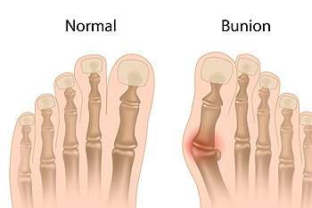 Cause and Care of Teen Bunions