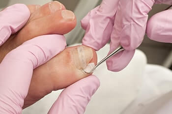 ingrown-toenail