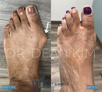 mis before and after02
