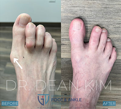 mis before and after03