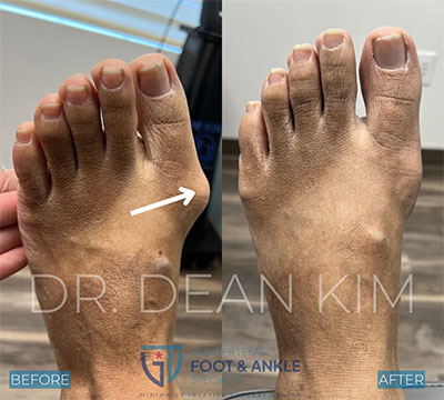 mis before and after04