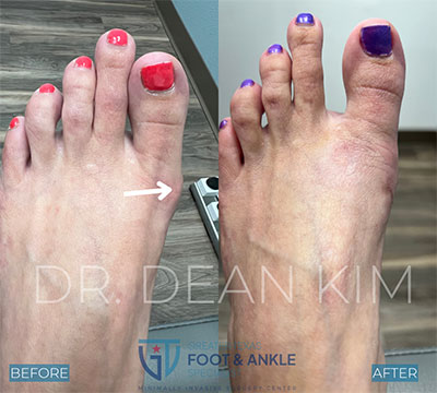 mis before and after11
