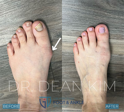 mis before and after14