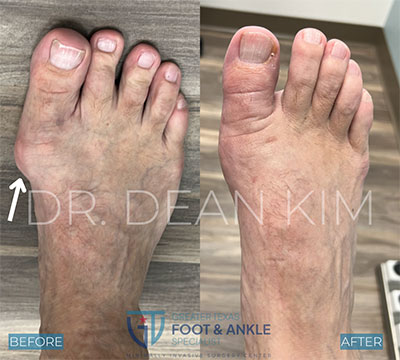 mis before and after15