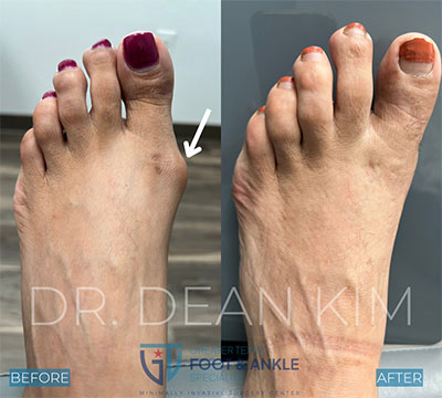 mis before and after16