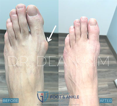 mis before and after17
