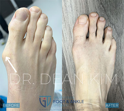 mis before and after18