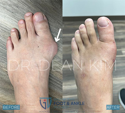 mis before and after19