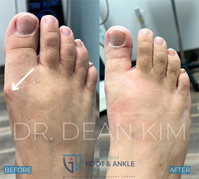 mis before and after20
