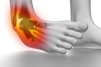 Definition and Causes of Acute Ankle Sprains