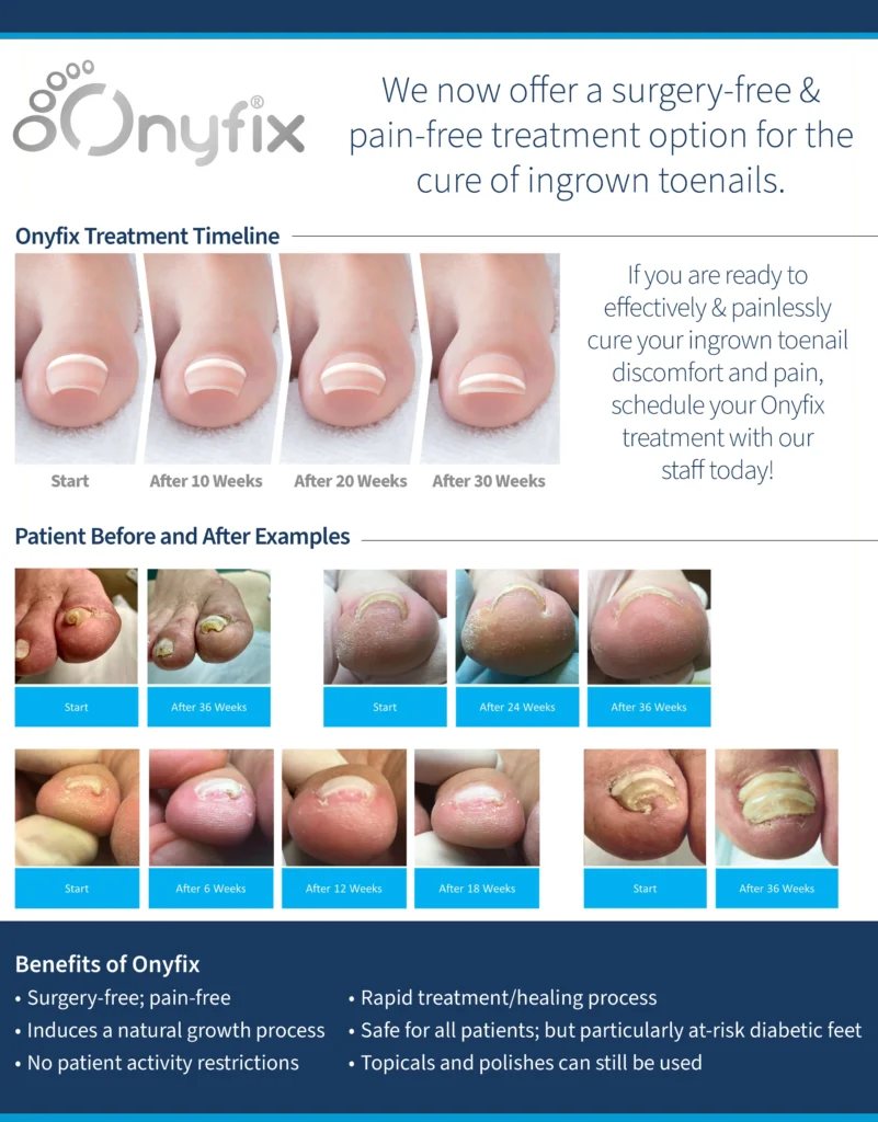 onyfix practice flyer before and afters