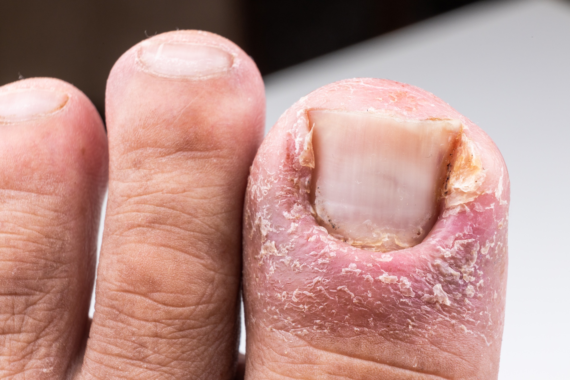 Ingrown toenail prevention